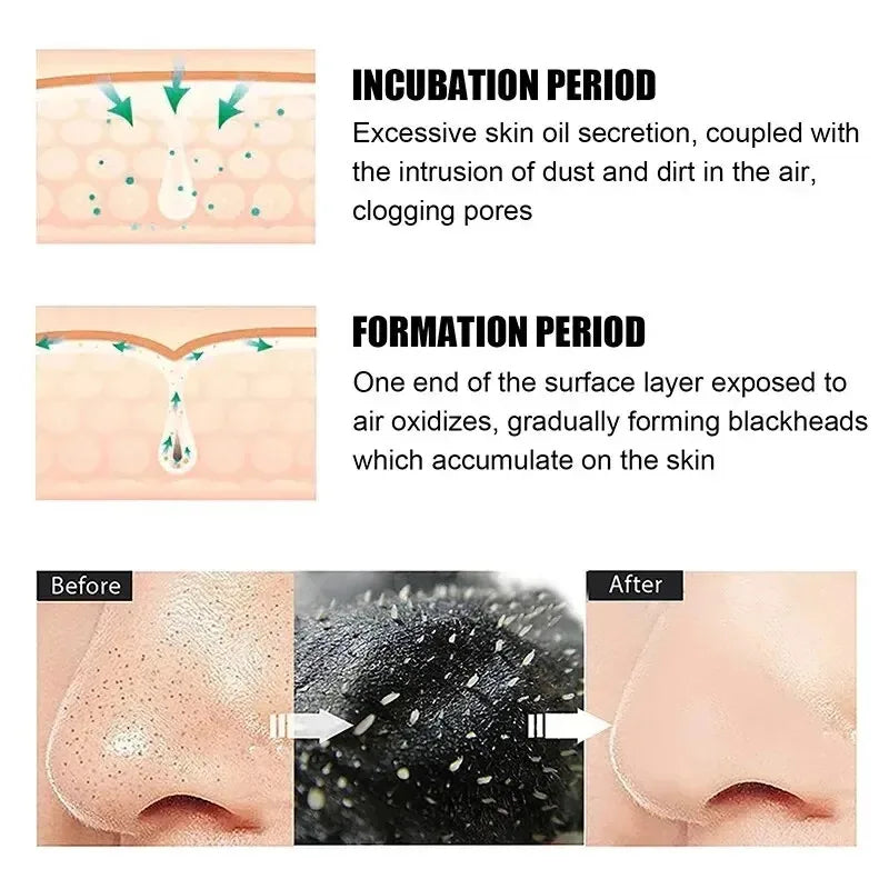 Blackhead Remover Nose Strips – Deep Pore Cleansing & Acne Treatment - Yusra Cart